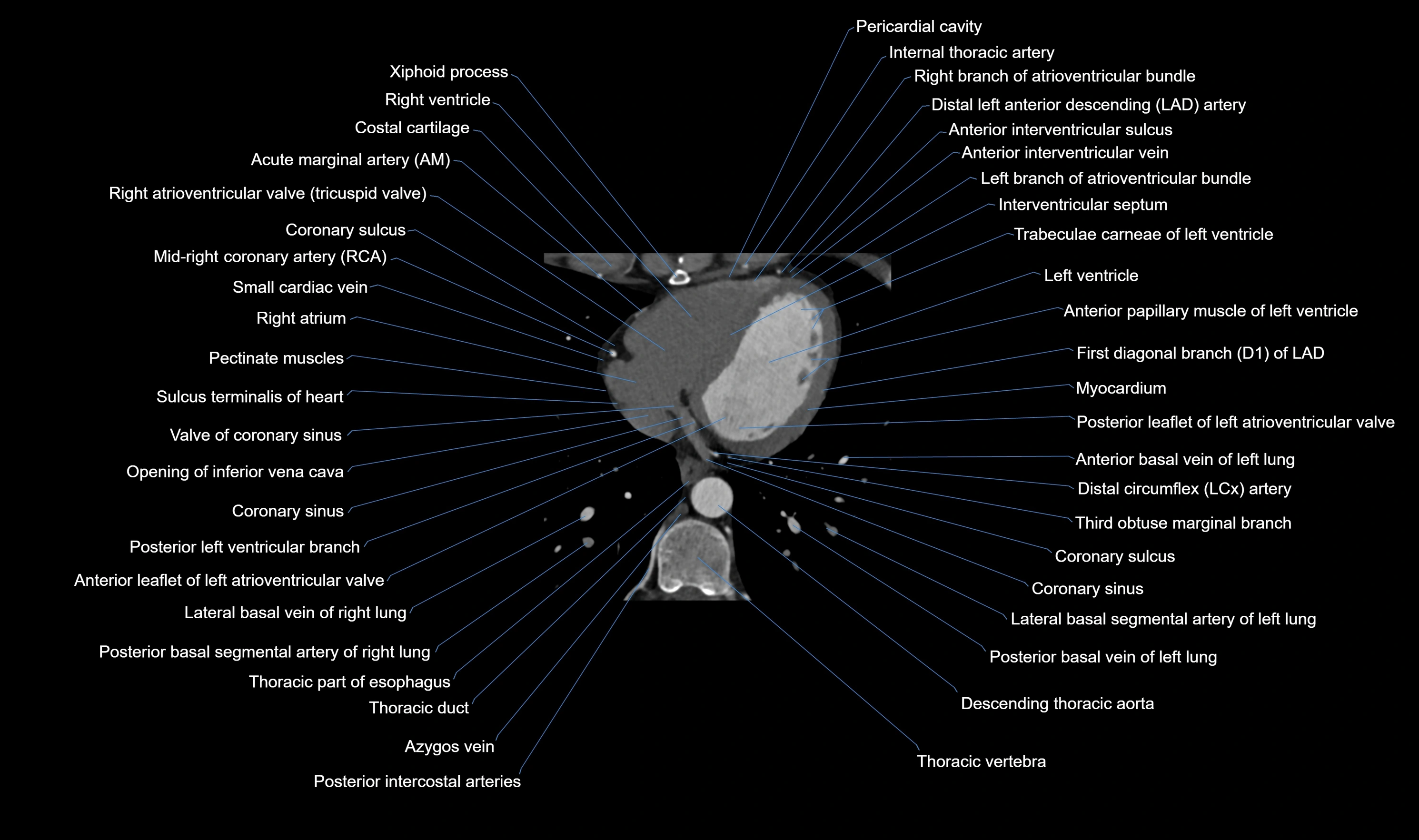 CT heart (coronary angiogram) axial view cross sectional anatomy labelled radiology image-00049.webp
